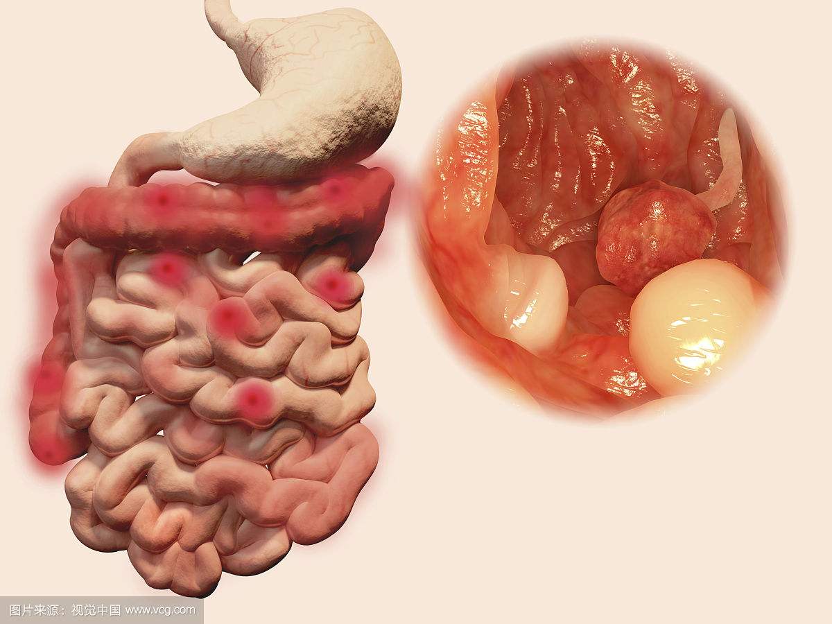 南寧腸道息肉怎么發(fā)現(xiàn)和治療