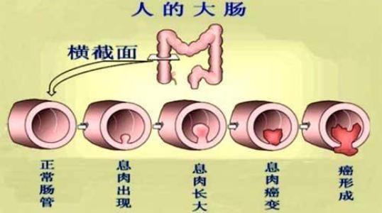 南寧治療結(jié)腸炎要多少費用