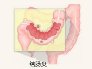 南寧治療結(jié)腸炎要花多少錢