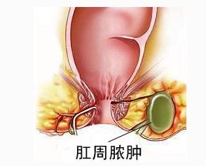 南寧肛周膿腫必須手術(shù)嗎